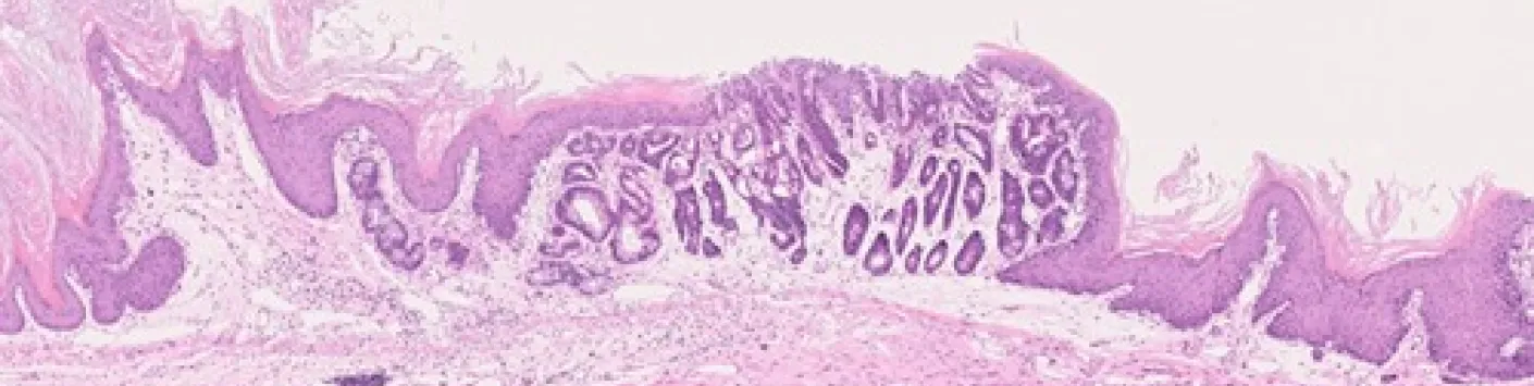 Cancer de l'oesophage : découverte des mécanismes impliqués